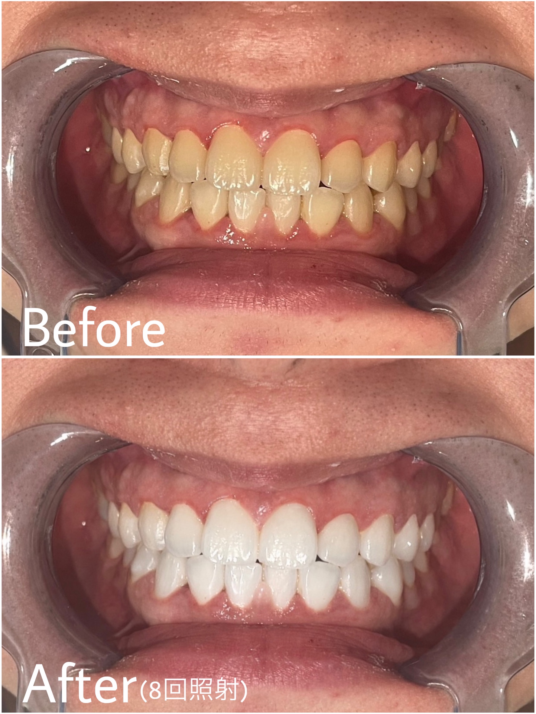 ホワイトニング